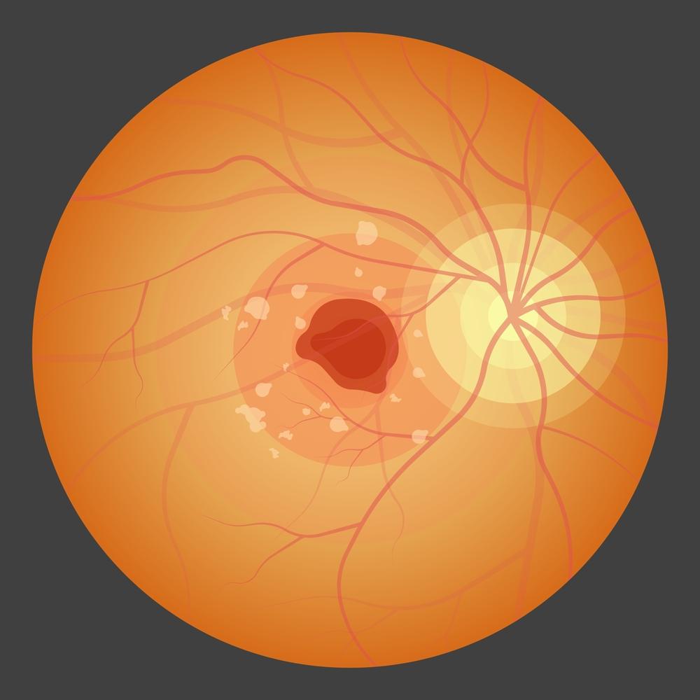 Cytomegalovirus (CMV) Eye Infections in Persons with AIDS
