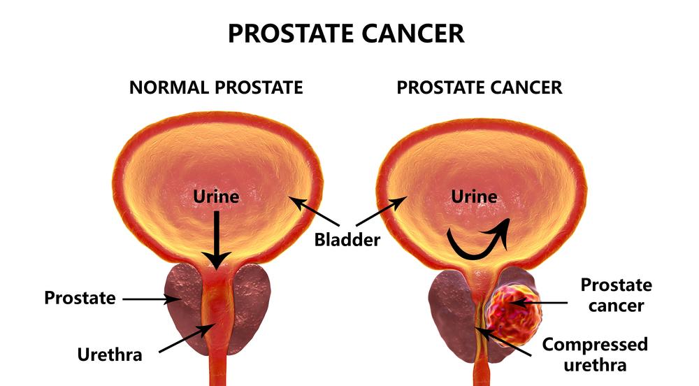 Prostate Cancer Understanding, Managing, and Preventing