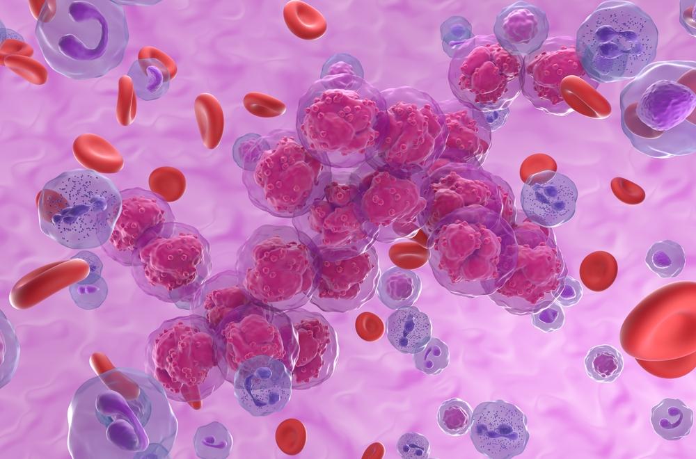Chronic lymphocytic leukemia - Symptoms, causes & Treatment