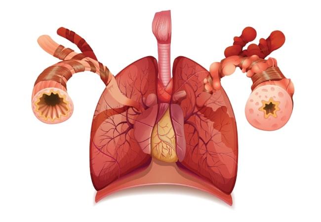 What is Asthma? Causes, Symptoms, Diagnosis, and Treatment