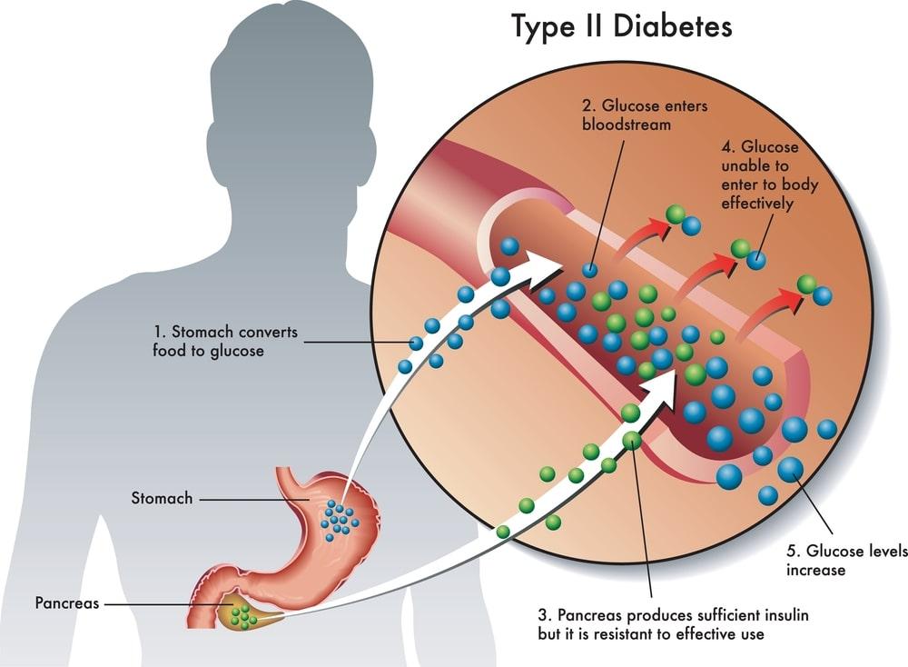 Overview of Type 2 Diabetes: Causes, Symptoms, and Treatment