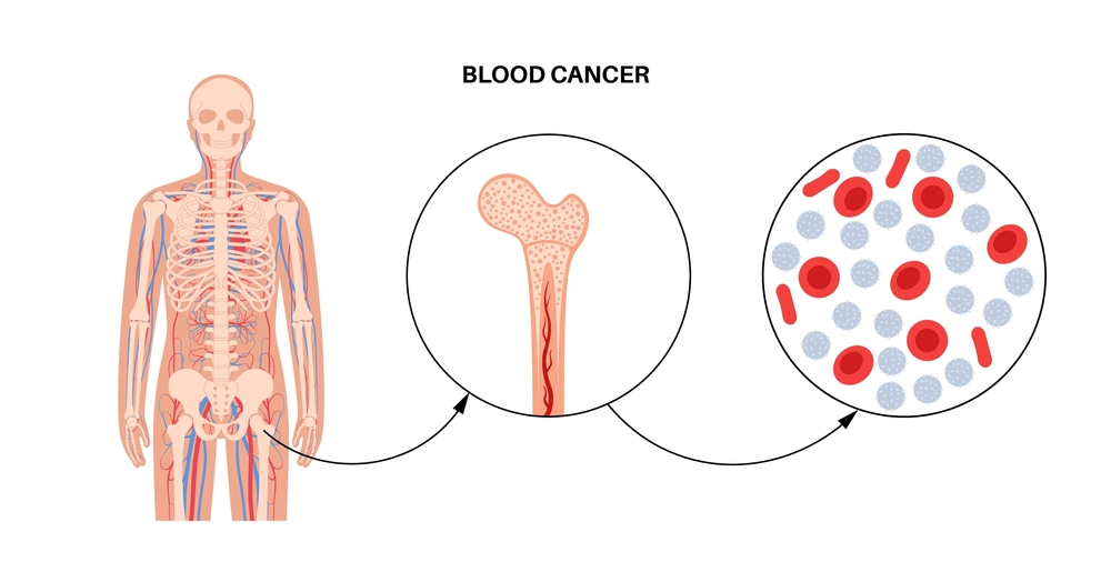 Ibrutinib: A Game-Changer in Blood Cancer Treatment